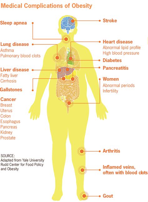 obesity associated morbidity wikipedia