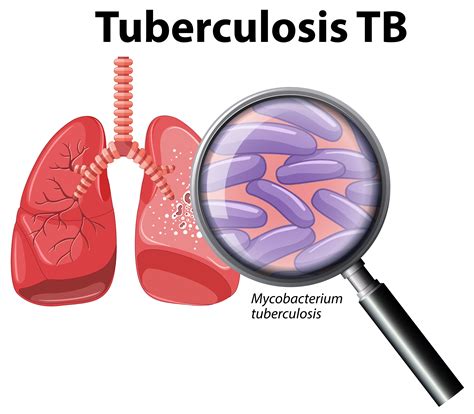 human lung  tuberculosis  vector art  vecteezy