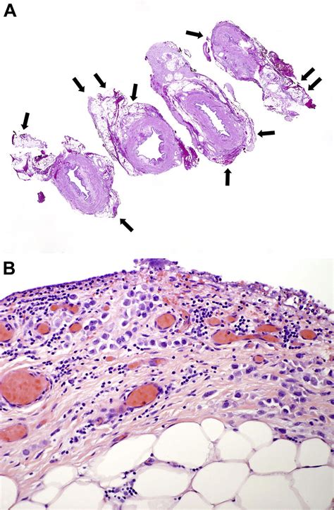 Plasmacytoid Bladder Cancer Variant Histology With