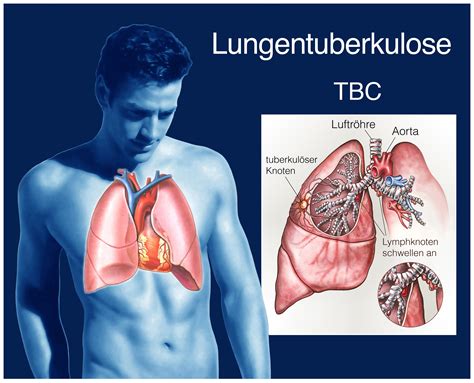 rki deutlicher anstieg der neuerkrankungen bei tuberkulose