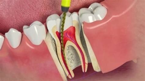 images  root canal