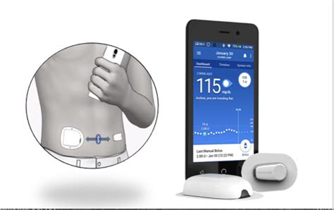 new omnipod® closed loop insulin delivery system improves glycemic control