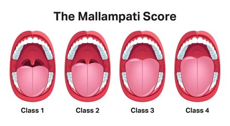 mallampati score  predicting sleep apnea sleep foundation