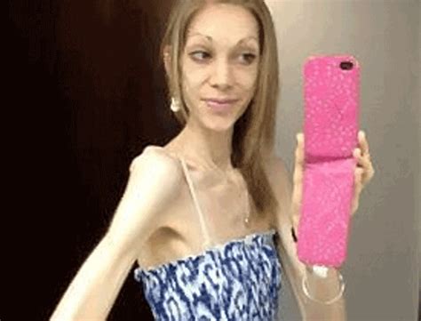 extreme anorexic nicola king beat her demons through