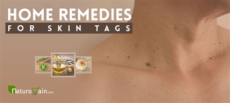 10 home remedies for skin tags effective and easy to use