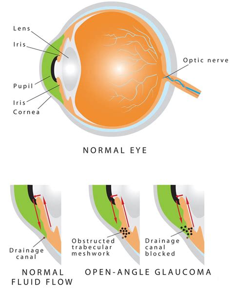 types  glaucoma glaucoma associates  texas