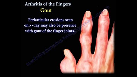 Arthritis Of The Fingers Types And Patterns Everything You Need To