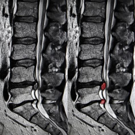 lumbar herniated disc  sciatica