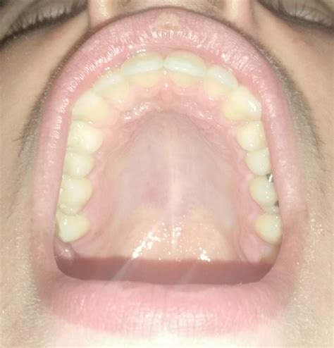 developed  small bump   roof   mouth   worried   dentistry