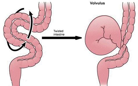 bowel obstruction small large  symptoms treatment