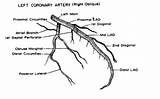 Coronary Arteries Artery Anatomy Left Heart Lad Oblique Cath Right Trunk Proximal Diameter Lab Cardiac Catheterization Nurse Report Disease 20mm sketch template