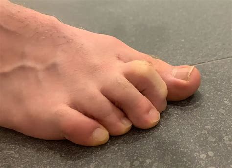 claw toe neurological    deformation podexpert