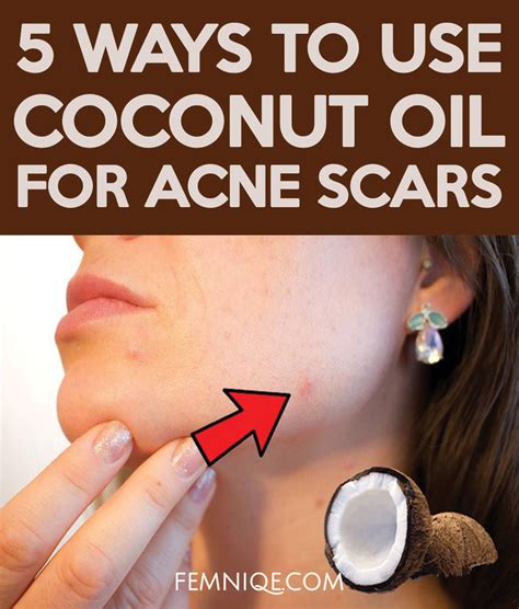 how to use coconut oil for acne scars 5 ways femniqe