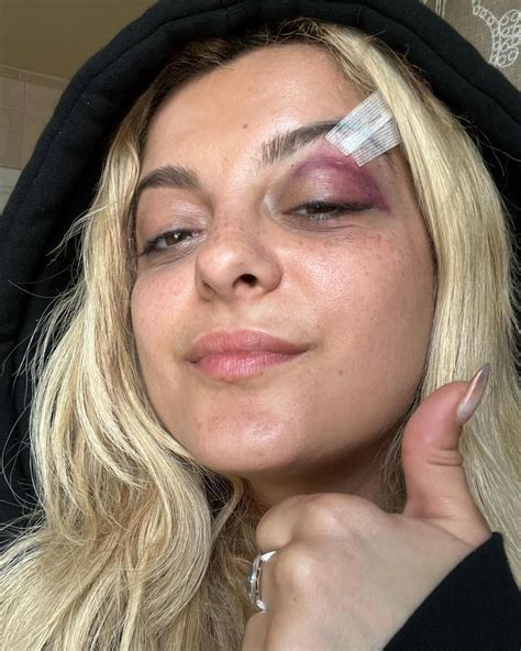 bebe rexha shares black eye   fan throws phone   face im good