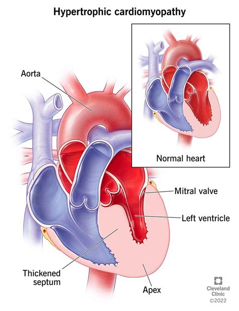 hypertrophic cardiomyopathy  symptoms treatments