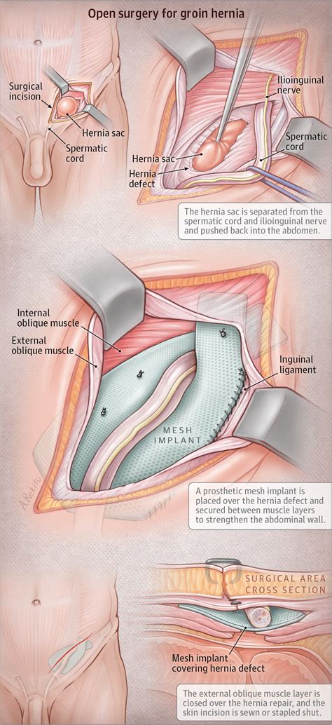 groin hernia repair by open surgery surgery jama jama network