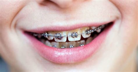 Do Braces Hurt What To Expect When You Get Braces