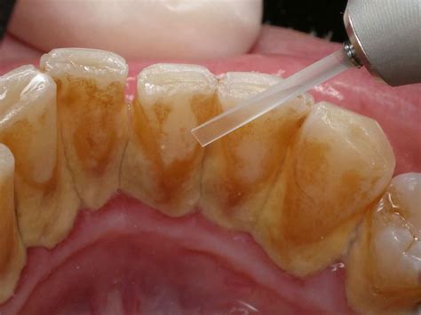 tartar dental calculus definition and tips to remove