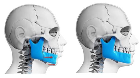 photograph mandibular jaw advancement  performed