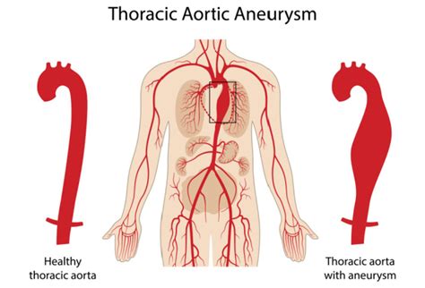 wat  het major criterium om preventief een aneurysma van de aorta