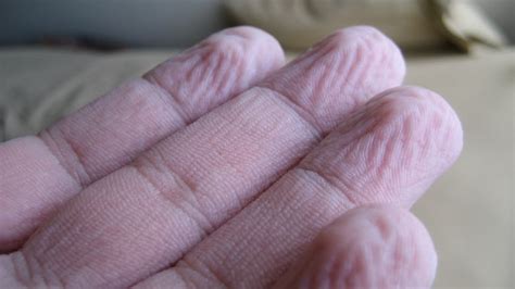 why do we get wrinkly fingers and toes when they re wet cbc radio