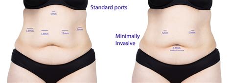 Scars From Gastric Sleeve Surgery How Your Stomach Will Look