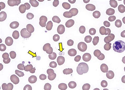 platelet count high  platelet count  treatment