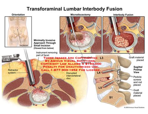 Transforaminal Lumbar Interbody Fusion