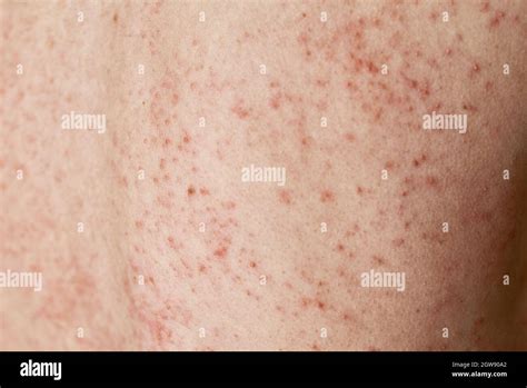allergischer hautausschlag frau mit dermatologieproblem auf der