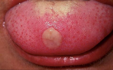 tongue bumps causes when to see a doctor and treatment