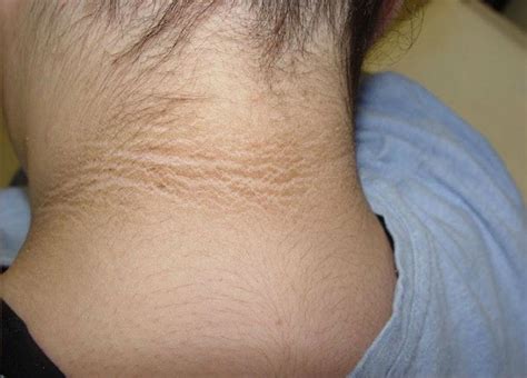 rid  dark neck   natural remedies  diagnosis