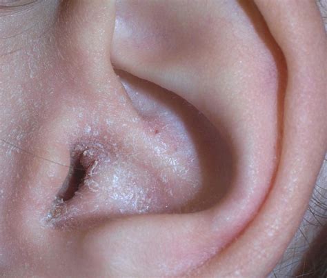 ear eczema symptoms   treatment