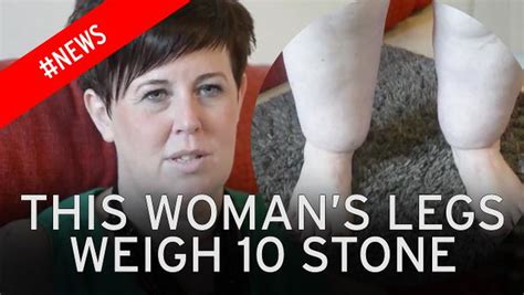 Woman Sheds Eight Stone But Has Been Left With Tree Trunk Legs Mirror
