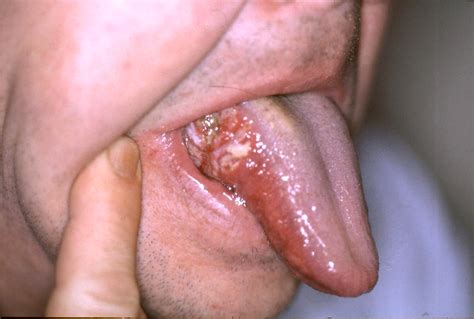 The First Sign You Ve Got Oral Cancer
