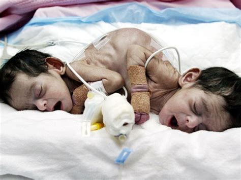 Conjoined Twins 40 Amazing Photos Graphic Images