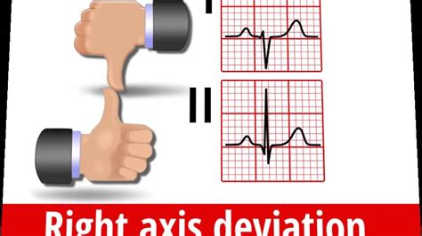 Ekg Axis Thumb Rule Hot Sex Picture