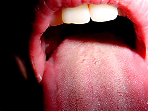 coated white tongue foul mouth what yucky signs say about your