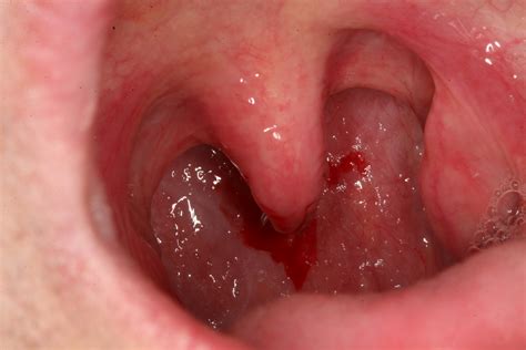 hpv warts lips pictures