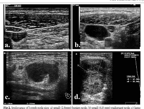 Figure From Ultrasonography Of Superficial Lymph Nodes My Xxx Hot Girl
