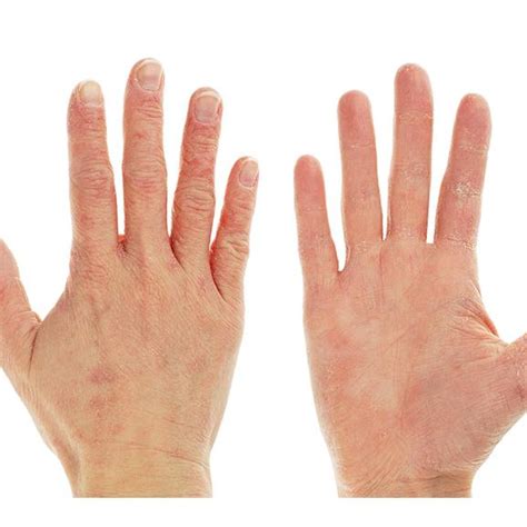 Eczema In Adults Pictures Atopic Dermatitis Symptoms