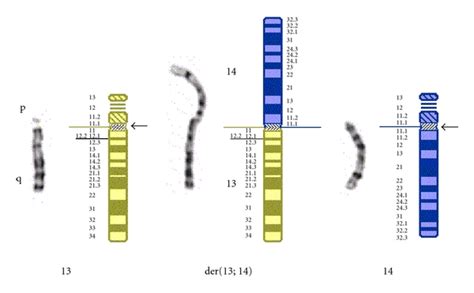 Inheritance Of A Ring Chromosome 21 In A Couple Undergoing In Vitro
