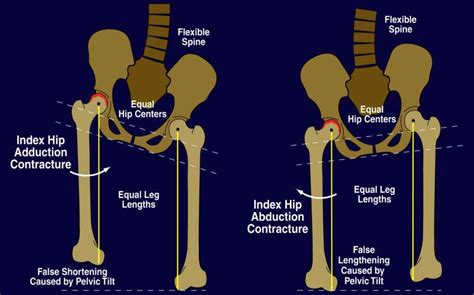 Tha Leg Length Discrepancy Recon Orthobullets