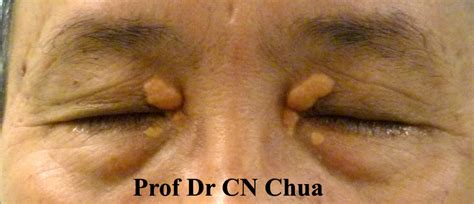 eyelid surgery  prof dr cn chua       yellowish lumps   eyelids