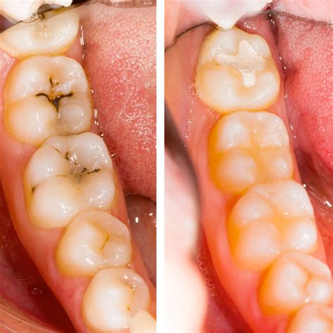cavity cavities cavity treatment  burlington dental