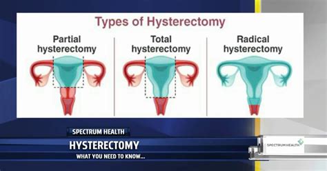 Hysterectomy What You Need To Know