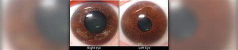 chronic narrow angle glaucoma eye disorders  diseases articles