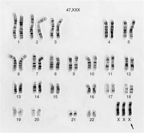 Triple X Chromosome Aberration Karyotype Wellcome Collection