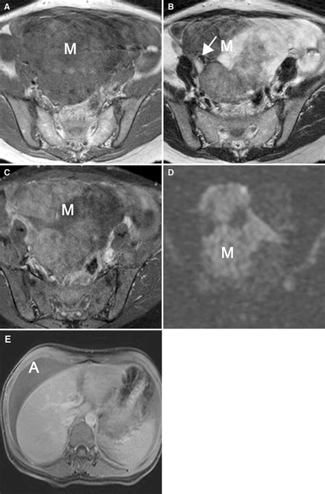Magnetic Resonance Imaging Features Of Ovarian Fibroma