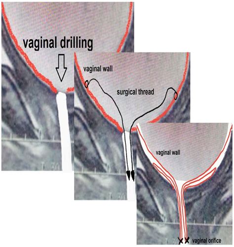 Congenital Imperforate Hymen Laghzaoui 2016 Bmj Case Reports