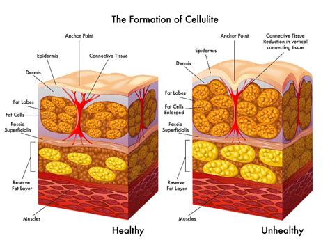 cellulite reduction invisa red™